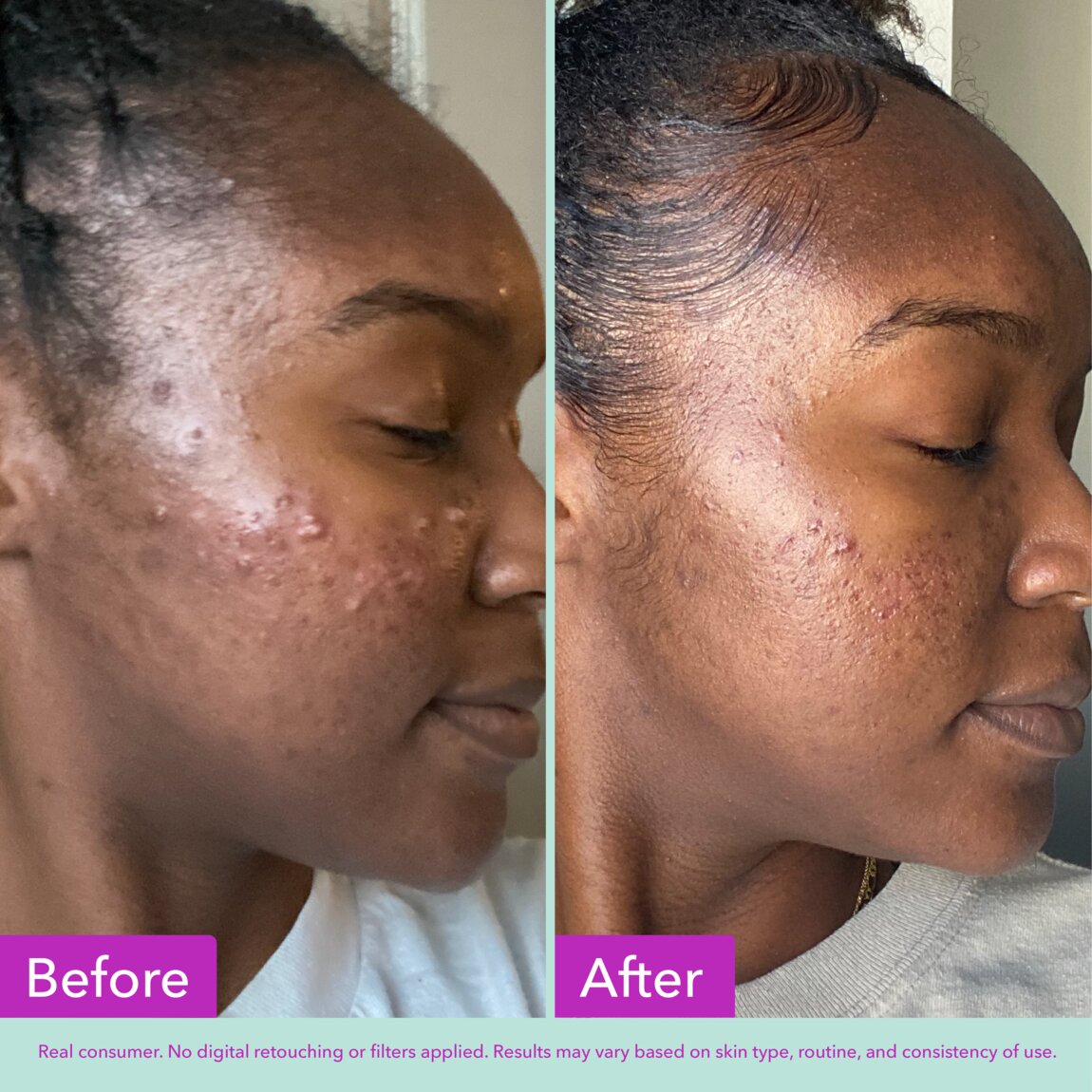 acne-foaming-cleanser-o2 zb_p.jpg